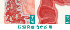 肠道疾病-典型病例