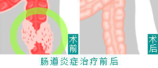 肠道疾病-典型病例