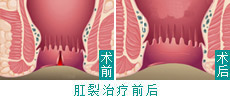 HCPT微创治疗肛裂实现新突