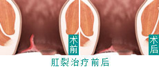 HCPT微创治疗肛裂实现新突