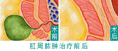 肛周脓肿病例