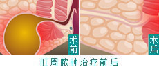 肛周脓肿病例