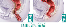 脱肛治疗前后效果图