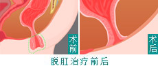 脱肛治疗前后效果图
