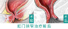 HCPT微创治疗肛裂实现新突