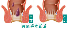 PPH手术治痔疮优势明显