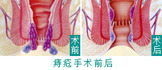 PPH手术治痔疮优势明显