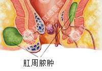 肛周脓肿百科