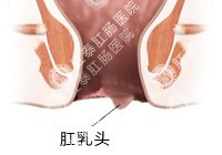肛乳头瘤百科
