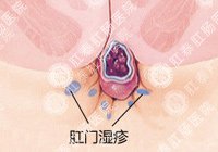肛门湿疹百科