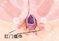 肛门瘙痒百科