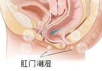 肛门潮湿百科