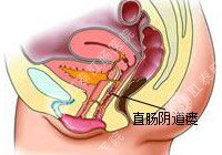 直肠阴道瘘百科