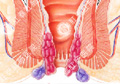 痔疮-典型病例