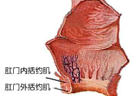 肛管内括约肌痉挛性收缩
