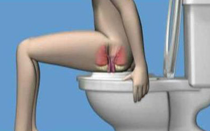 福州专业治疗肛瘘的医院?