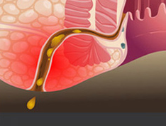 福州哪家医院专治肛瘘?